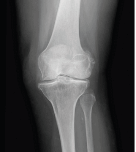 Röntgenaufnahme eines arthrotisch veränderten Kniegelenks (von vorne)