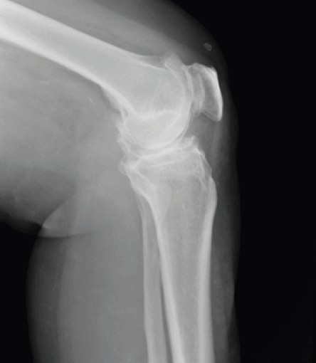 Röntgenaufnahme eines Kniegelenks (von der Seite)